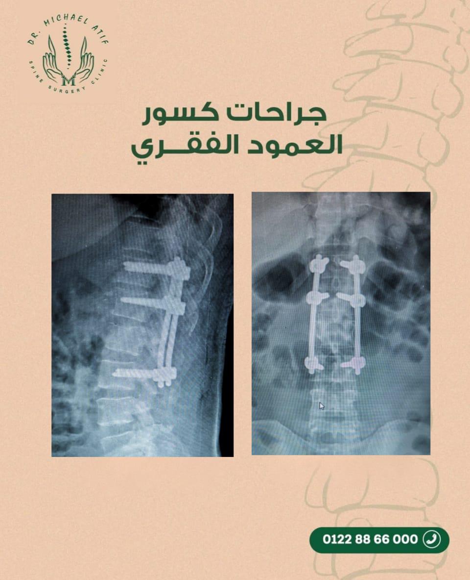 Spine Fractures