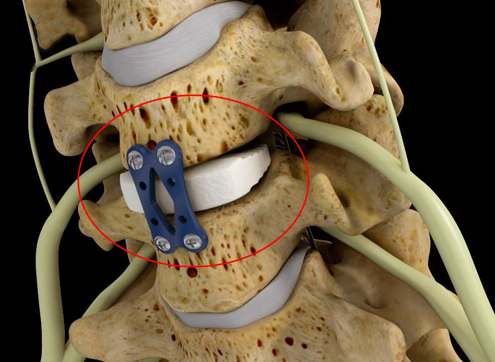 Cervical Disc
