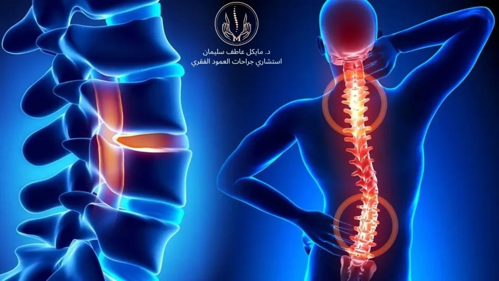 تشوهات العمود الفقري​ وأحدث طرق العلاج مع د. مايكل عاطف