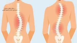 عملية اعوجاج العمود الفقري: أحدث التقنيات الجراحية - د مايكل عاطف