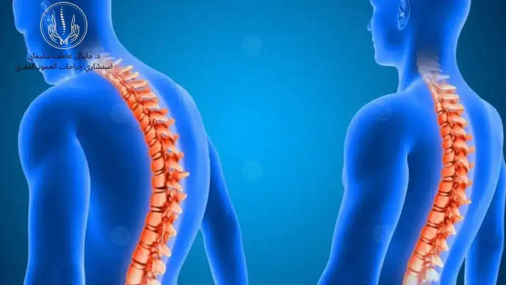 عملية اعوجاج العمود الفقري: أحدث التقنيات الجراحية - د مايكل عاطف