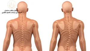 علاج اعوجاج العمود الفقري عند الكبار - الأسباب والأعراض وأحدث طرق العلاج - د. مايكل عاطف