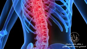 كسور العمود الفقري - الأنواع والتشخيص والعلاج مع د مايكل عاطف