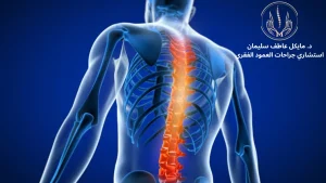 كيف تضمن أنجح جراحة للعمود الفقري مع د. مايكل عاطف