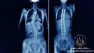 هل جراحات اعوجاج العمود الفقري امنه؟ - د. مايكل عاطف