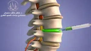 أفضل أنواع حقن الفقرات القطنية - د. مايكل عاطف