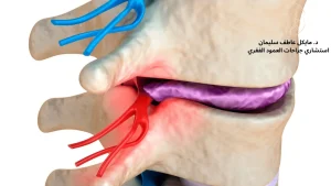 متى يكون استئصال الغضروف العنقي ضرورة جراحية لا تحتمل التأجيل - د. مايكل عاطف